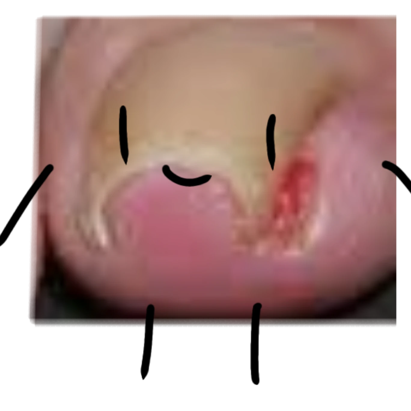 내성발톱